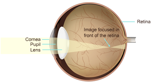 Nearsightedness