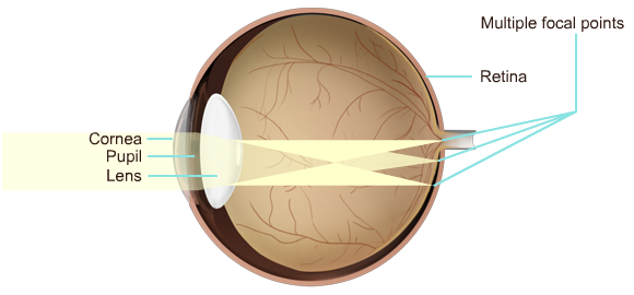 Astigmatism